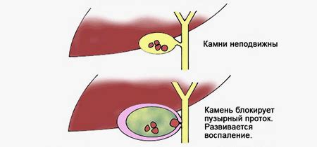 Лечение холецистита. Причины и симптомы воспаления желчного пузыря ...