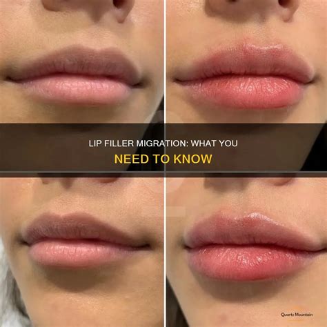 Lip Filler Migration: What You Need To Know | QuartzMountain