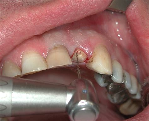 Why Do Dentists Pull Out Teeth? - BSGF