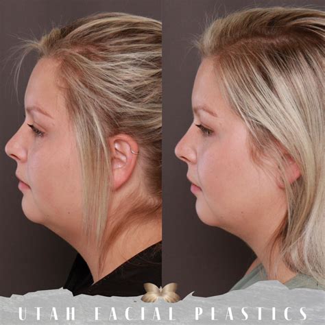 Pin on Surgical Procedures