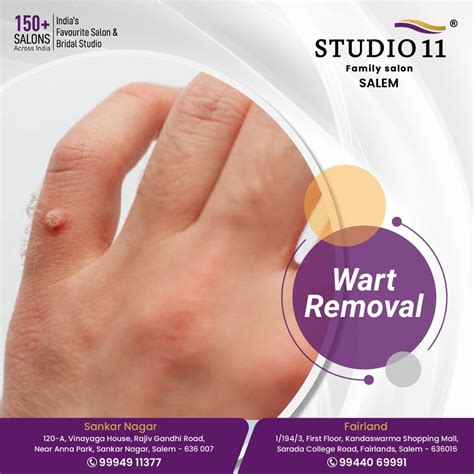 Yes you can remove a plantar wart with duct tape – Artofit