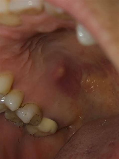 Lump inside roof of mouth - abscess? Looking for advice. : r/Dentistry