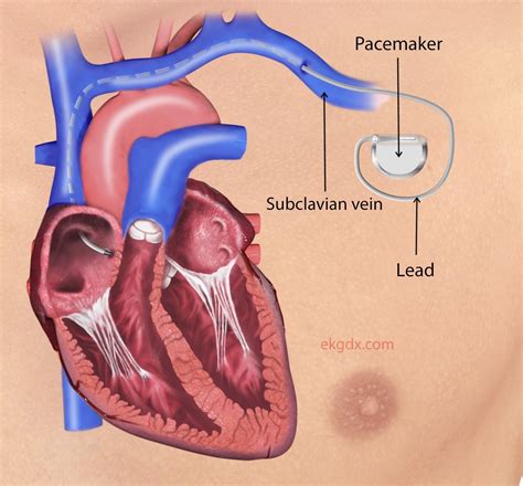 EKGDX - Atrial pacing, the forgotten pacing mode.