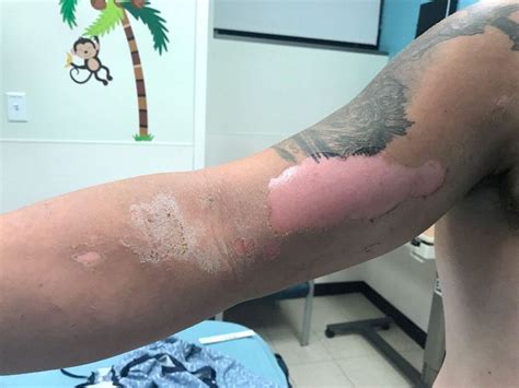 3rd Degree Burns On Arm