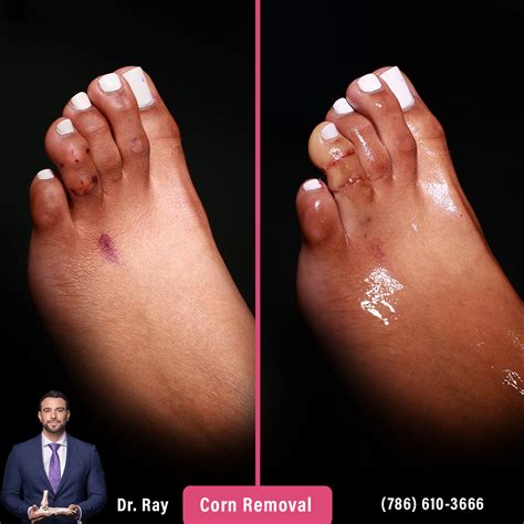Corn Removal Surgery Before and After Photos - Luxe Foot Surgery