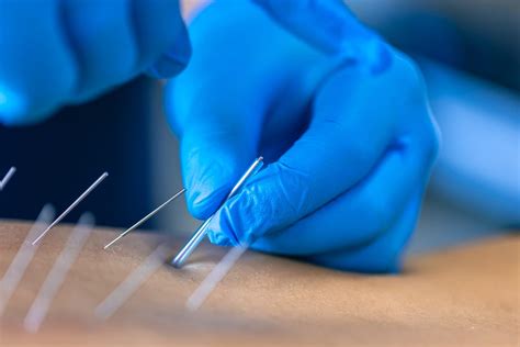 Dry Needling | Arpella Physical Therapy