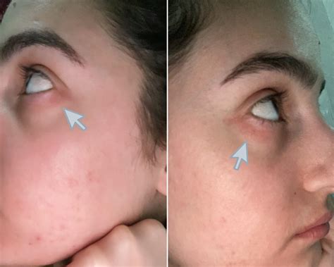 Eyes Itchy Corner at Jason Rocha blog