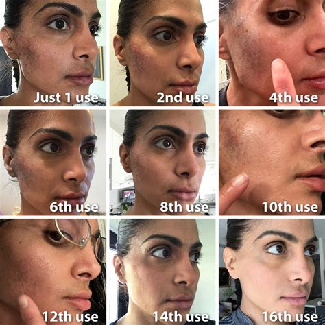 Hydroquinone Cream Before And After