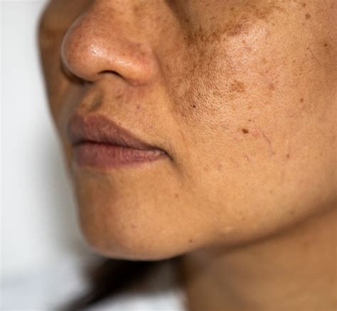 Skin Tags: Understanding Causes, and Treatments | Johns Creek Dermatology MD