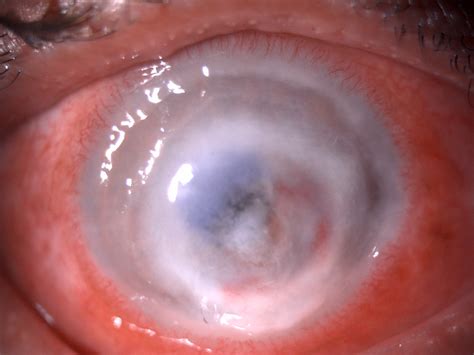 Ulcer In Eye