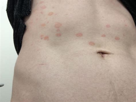 Itchy Rash On Stomach And Sides at Donna Willey blog
