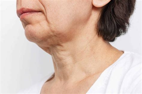 Sagging Neck: Best treatment to treat it | Dr. Anthony Bared | Miami