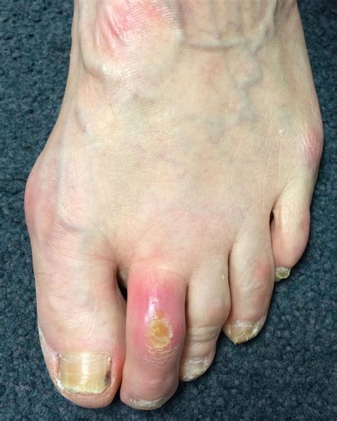 What Causes Pressure Sores On Toes at Lorraine Edwards blog