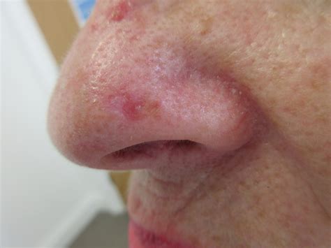 BCC on The Nose – Basal Cell Carcinoma Picture | Mr Tehrani – Mohs Surgeon