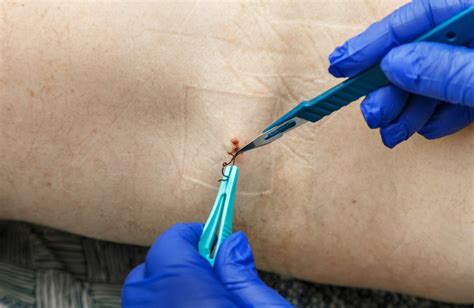 Does Suture Removal Hurt? Medico Sutures Explains
