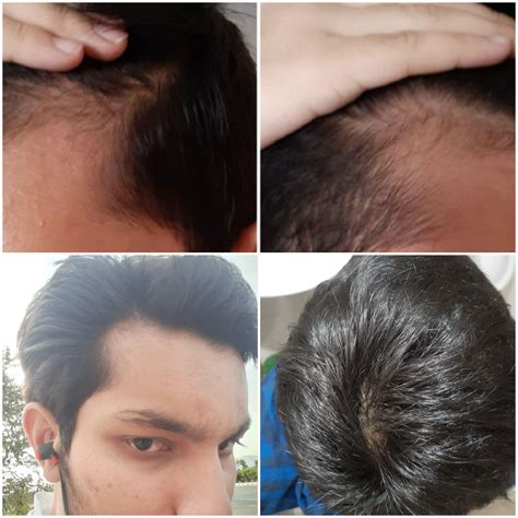 [M18] Am I balding? My dad is bald while my uncle has luscious hair. My ...