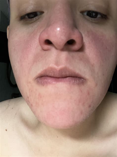Hey guys! I recently been getting these rash like pimples around my ...
