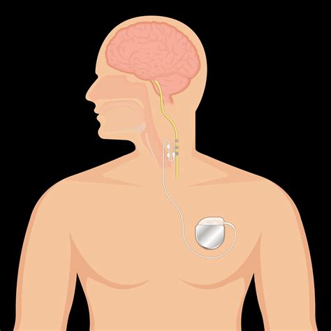 Peripheral Nerve Stimulation - Suvar MD