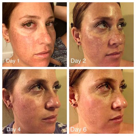 Fractional Laser Resurfacing | San Diego, CA | CLDerm