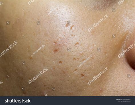 Holes In Skin From Acne