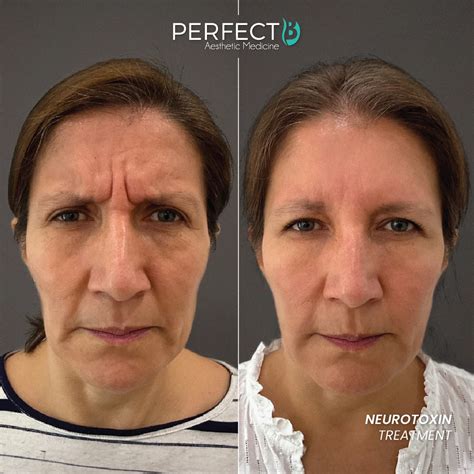 Neurotoxin Treatment | Perfect B