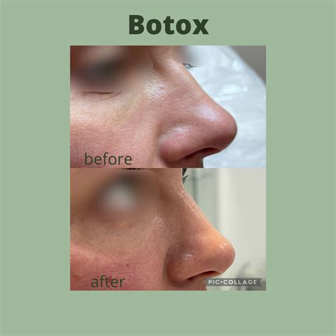Before and after Botox on the nose | Botox before and after, Face lift surgery, Botox
