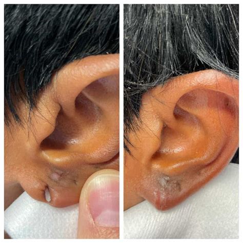 Otoplasty St. Louis - Ear Plastic Surgery St. Louis - Ear Reduction Surgery - Earlobe repair St ...