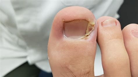 Care For Ingrown Toenail Removal at Carolyn Fischer blog