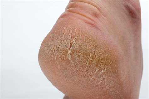 What Causes Cracked Heels & How Can They Be Treated?