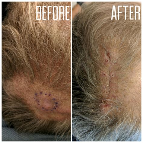 Skin Cancer Scalp Treatment