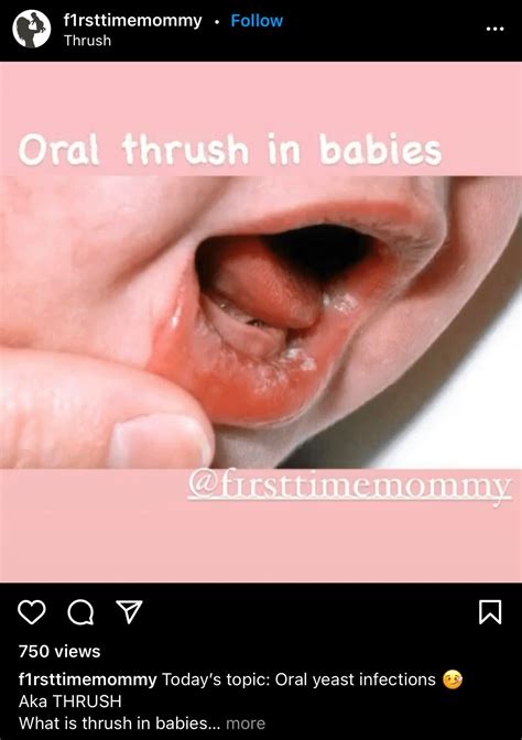 Complete Guide to Treating Thrush (Pictures) — Mattos Lactation