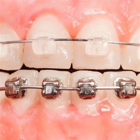 #1 Clear Braces vs Metal | Renew Wellness Dentistry Best Guide