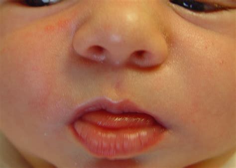 Neonatal Acne (Acne - neonatal and infantile) - Dermatology Advisor