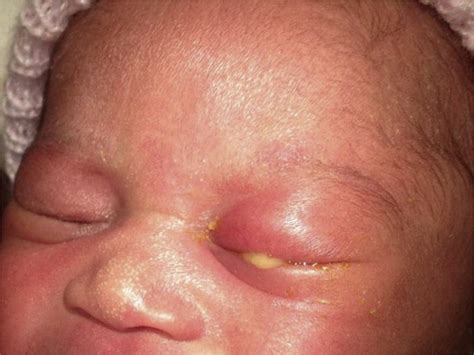 Neonatal Gonorrhea Eye Infection: Causes, Symptoms, Prevention, and ...