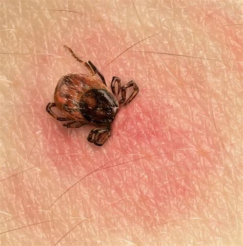 First Fatal Case of Tick-Borne Encephalitis Confirmed at Botkin Hospital