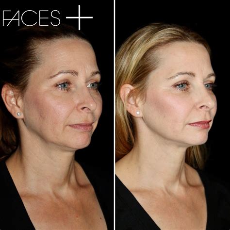 Mini-Lift | Mini face lift, Face plastic surgery, Best plastic surgeons