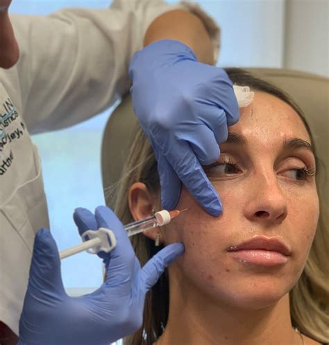Cheek Fillers 101: Everything You Need to Know - Carolina Facial Plastics