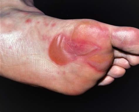 Reddish Soles Of Feet