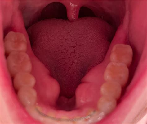 Mandibular tori removal : r/askdentists