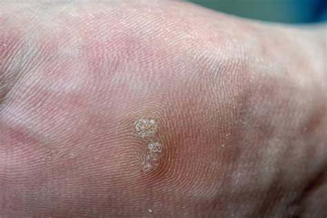 Plantar Wart Vs Foot Corn at Sebastian Lyne blog