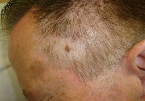 Melanoma On Ear at Hubert Moreno blog