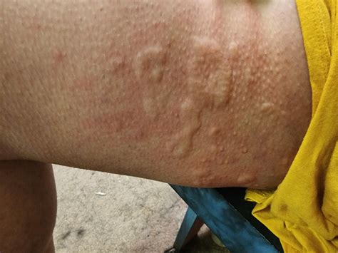 Pea sized lumps deep in thigh : r/medical