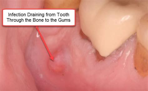 What Causes A Root Canal To Abscess