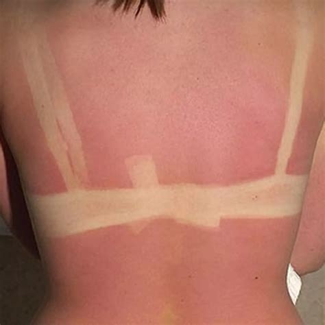 Tanning Bed Burns