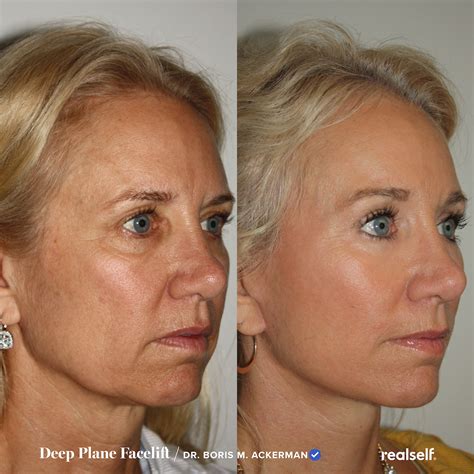 Deep plane facelift procedure cost recovery – Artofit