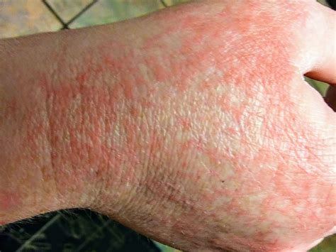 COVID-19 Rash in Adults: Signs During & After Infection