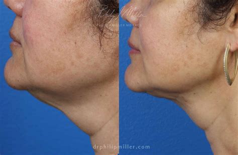 Double Chin Removal | Dr. Philip Miller