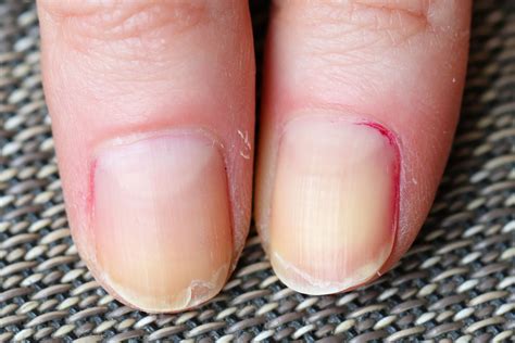What Causes Brittle Breaking Fingernails at Angeline Barron blog