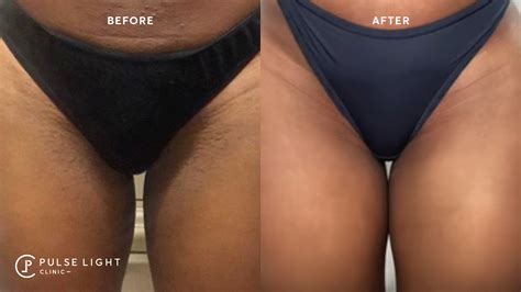 Laser Hair Removal Before And After Bikini
