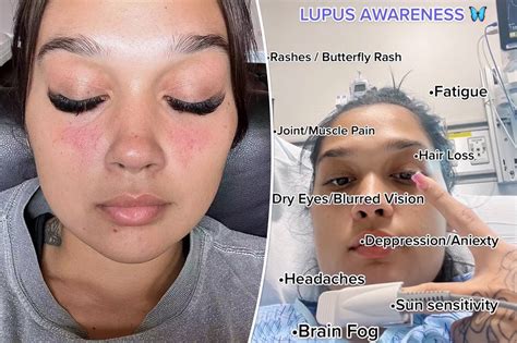 Lupus Symptoms Rash On Face